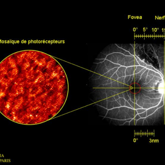 La zone observée couvre un disque de 300 µm de diamètre sur la rétine, soit 1° de champ, à 0,5 mm du bord de fovéa, la partie centrale de la rétine. La caméra est focalisée sur une couche située à 240 µm sous la surface, et l'illumination, à 0,5 µm de longueur d'onde, a duré 7 ms. Chaque granule, ici de 2 à 4 µm de diamètre, est un photorécepteur de type "cône" (les bâtonnets sont beaucoup plus minces et encore difficiles à détecter). Dans cette région, l'espacement inter-cône est en moyenne de 5 µm, s[...]